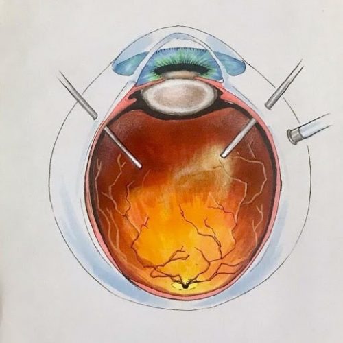 Cirurgia de Retina Vitrectomia CLÍNICA VISÃO